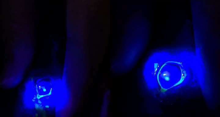 荧光素染色检查